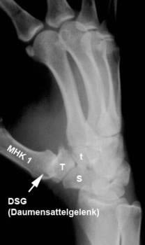 rhizarthrose stt arthrose - Plastische Chirurgie & Handchirurgie
