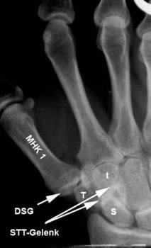 stt arthrose bonn - Plastische Chirurgie & Handchirurgie